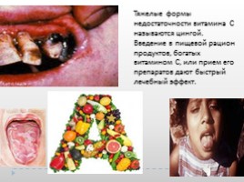 Гиповитаминозы, слайд 16