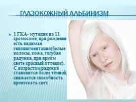 Альбинизм, слайд 6