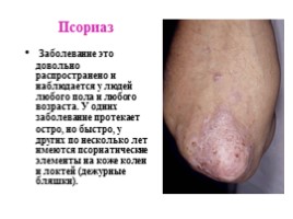 Заболевания кожи, слайд 19