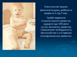Наследственные болезни человека, слайд 27