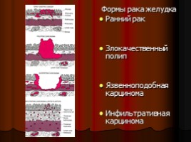 Заболевания верхних отделов желудочно-кишечного тракта, язва, слайд 53