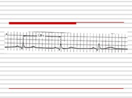 Аритмии сердца, слайд 11
