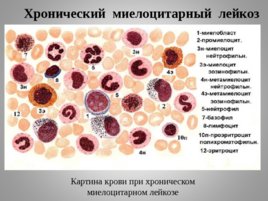 Опухоли кроветворной и лимфоидной тканей Часть II, слайд 16