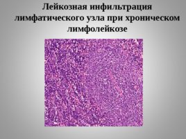 Опухоли кроветворной и лимфоидной тканей Часть II, слайд 31