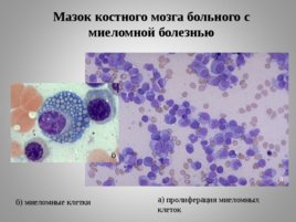 Опухоли кроветворной и лимфоидной тканей Часть II, слайд 37
