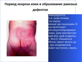 Гнойно-восполительные заболевания кожи и подкожной клетчатки у детей, слайд 30