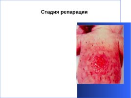 Гнойно-восполительные заболевания кожи и подкожной клетчатки у детей, слайд 31