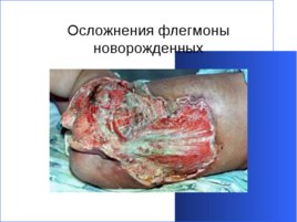 Гнойно-восполительные заболевания кожи и подкожной клетчатки у детей, слайд 33