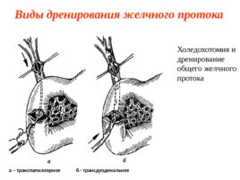 Топографическая анатомия и оперативная хирургия общего желчного протока, слайд 14