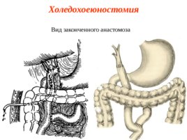 Топографическая анатомия и оперативная хирургия общего желчного протока, слайд 20