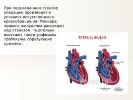 Тетрада Фалло, слайд 20