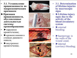 Травматология (общие вопросы), слайд 52