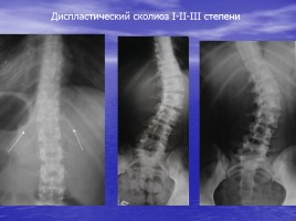 Коррекция нарушений ОДА средствами физического воспитания, слайд 20