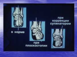 Коррекция нарушений ОДА средствами физического воспитания, слайд 33