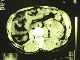 Повреждения мочеполовых органов, слайд 22