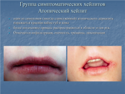 Хейлит – это воспалительное или дистрофическое заболевание губ с преимущественным поражением красной каймы губ, слайд 11