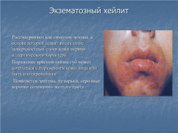 Хейлит – это воспалительное или дистрофическое заболевание губ с преимущественным поражением красной каймы губ, слайд 12