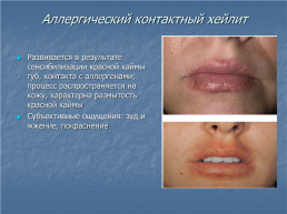 Хейлит – это воспалительное или дистрофическое заболевание губ с преимущественным поражением красной каймы губ, слайд 5