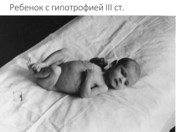 Гипотрофия у новорожденных, слайд 13