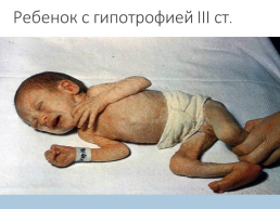 Гипотрофия у новорожденных, слайд 15