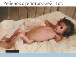 Гипотрофия у новорожденных, слайд 16
