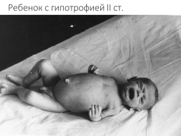 Гипотрофия у новорожденных, слайд 8