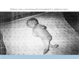 Гипотрофия у новорожденных, слайд 9