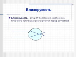 Близорукость - Причины возникновения и профилактика заболевания, слайд 3