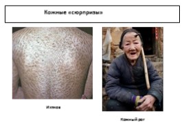 Заболевания кожи, слайд 15