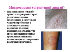 Заболевания кожи, слайд 17