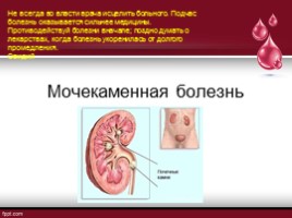 Мочекаменная болезнь, слайд 1