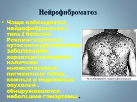 Наследственные болезни человека, слайд 72