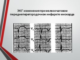 Гипертоническая болезнь, слайд 46