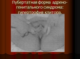 Нарушения менструальной функции - Нейроэндокринные синдромы в гинекологии, слайд 41