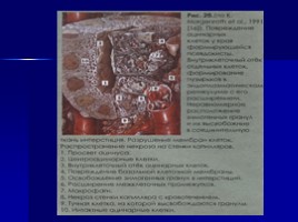 Хронический панкреатит, слайд 41