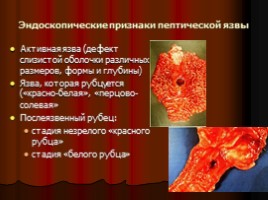 Заболевания верхних отделов желудочно-кишечного тракта, язва, слайд 36