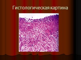 Заболевания верхних отделов желудочно-кишечного тракта, язва, слайд 41