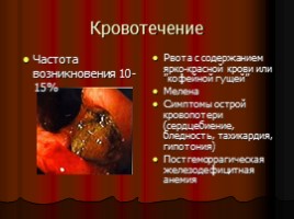 Заболевания верхних отделов желудочно-кишечного тракта, язва, слайд 44