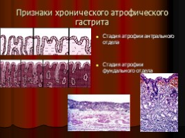 Заболевания верхних отделов желудочно-кишечного тракта, язва, слайд 52