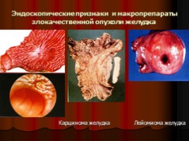 Заболевания верхних отделов желудочно-кишечного тракта, язва, слайд 54