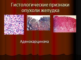 Заболевания верхних отделов желудочно-кишечного тракта, язва, слайд 55