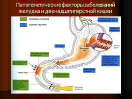 Заболевания верхних отделов желудочно-кишечного тракта, язва, слайд 6