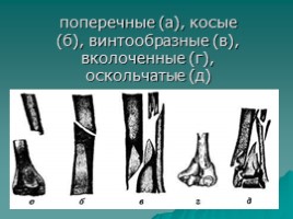 Оказание первой медицинской помощи при ушибах, переломах, слайд 12