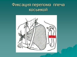 Оказание первой медицинской помощи при ушибах, переломах, слайд 18