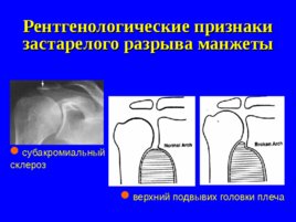 Травматология и ортопедия повреждений и заболеваний плечевого сустава-1, слайд 22
