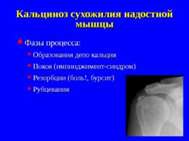 Травматология и ортопедия повреждений и заболеваний плечевого сустава-1, слайд 37