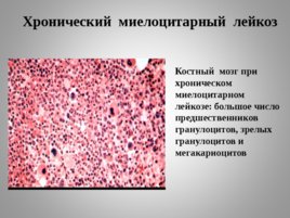 Опухоли кроветворной и лимфоидной тканей Часть II, слайд 17