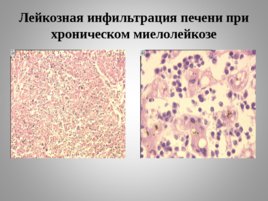 Опухоли кроветворной и лимфоидной тканей Часть II, слайд 18