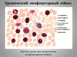 Опухоли кроветворной и лимфоидной тканей Часть II, слайд 29