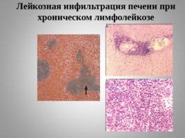 Опухоли кроветворной и лимфоидной тканей Часть II, слайд 30